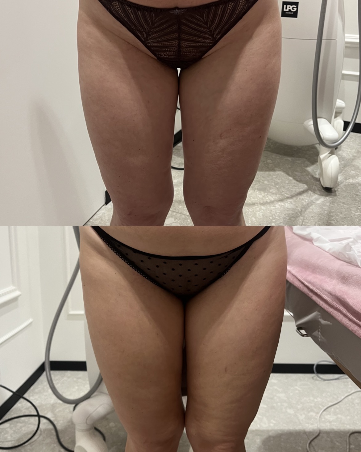 Efekt modelowania sylwetki endermologią