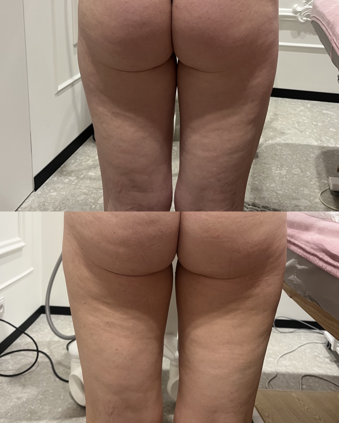 Efekt modelowania sylwetki endermologią