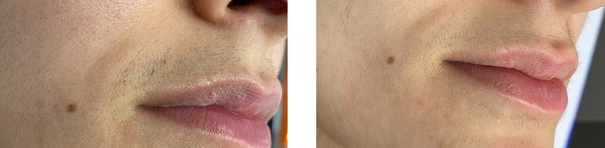 Efekt epilacji laserowej Motus Pro w Skin IQ