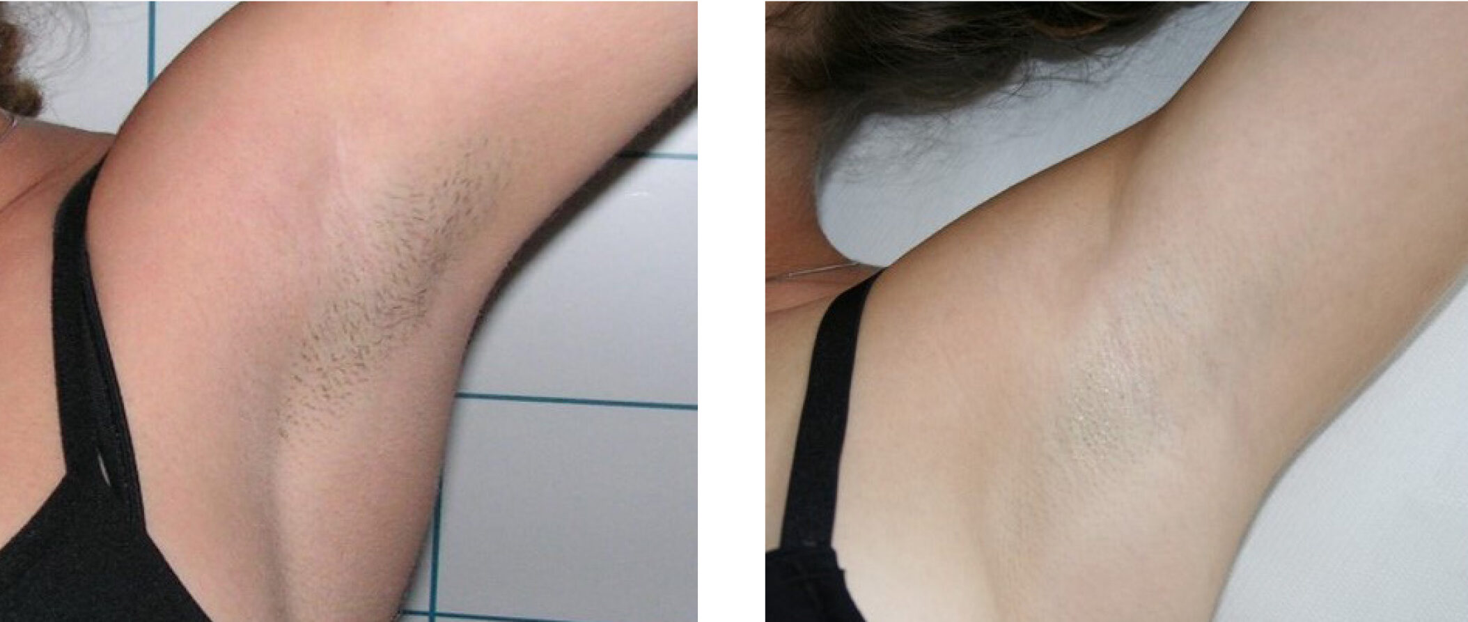 Efekt epilacji laserowej Motus Pro w Skin IQ