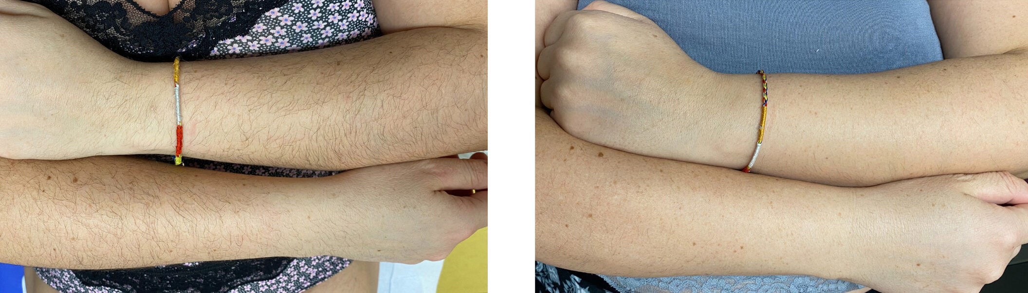 Efekt epilacji laserowej Motus Pro w Skin IQ