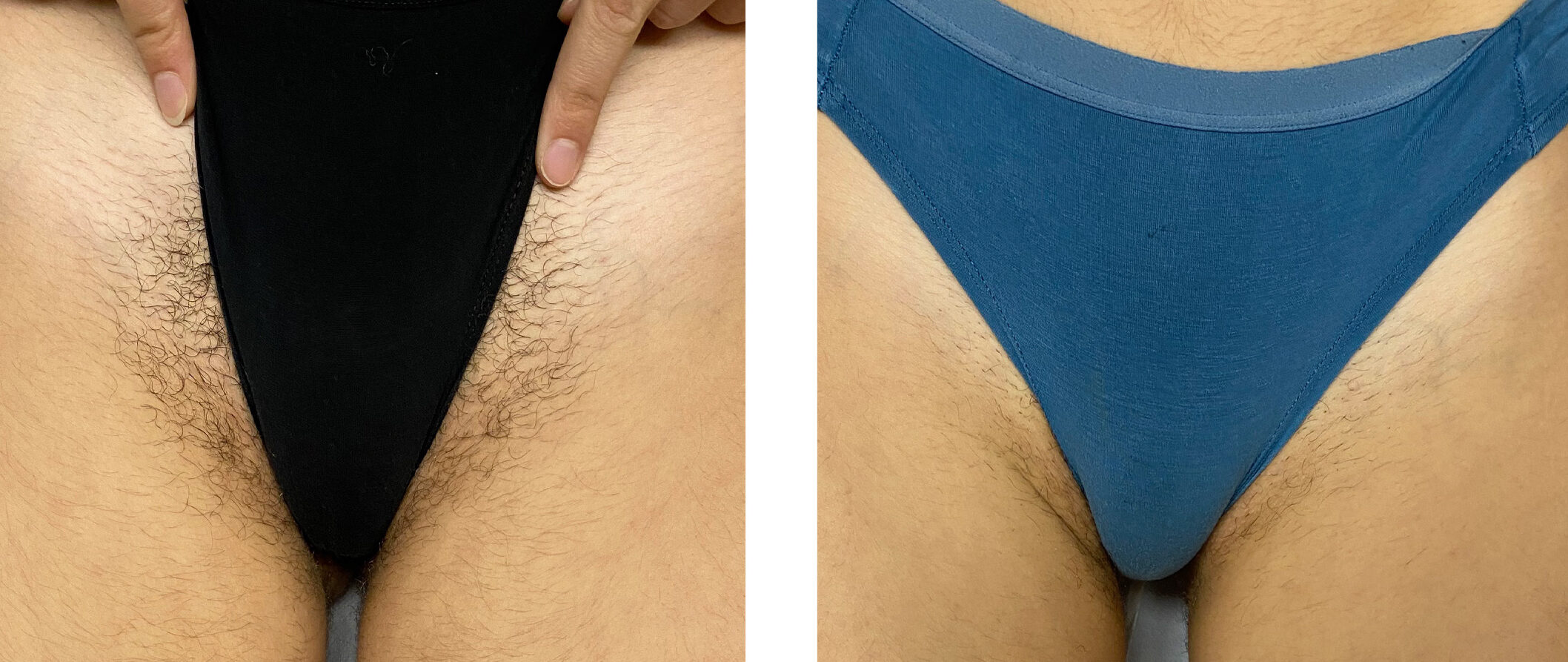 Efekt epilacji laserowej Motus Pro w Skin IQ