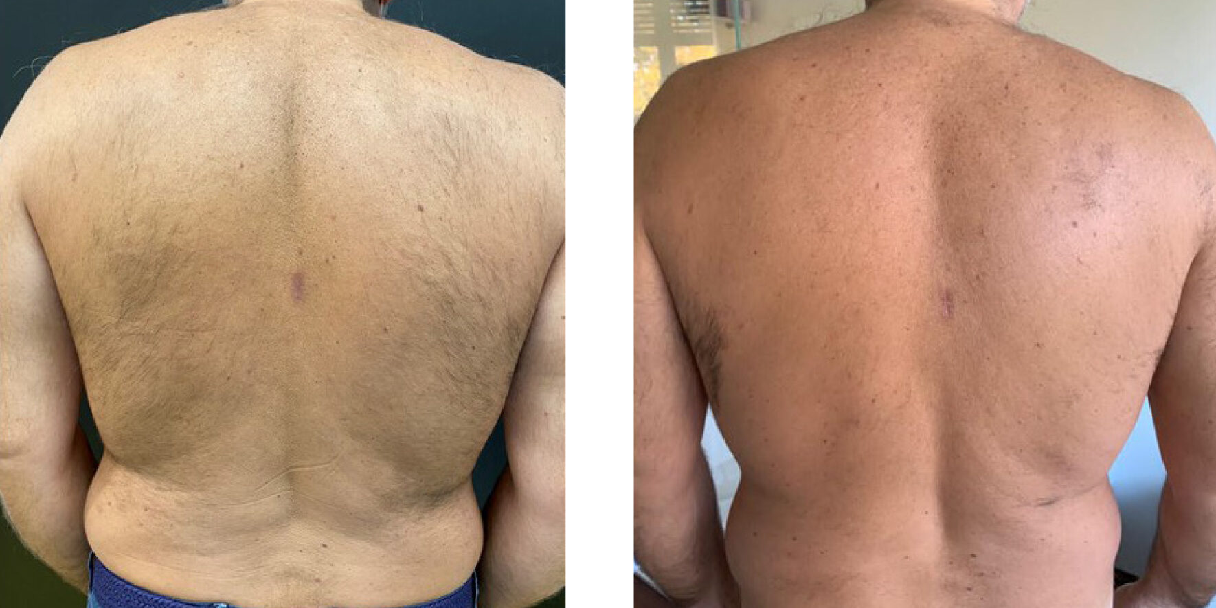 Efekt epilacji laserowej Motus Pro w Skin IQ