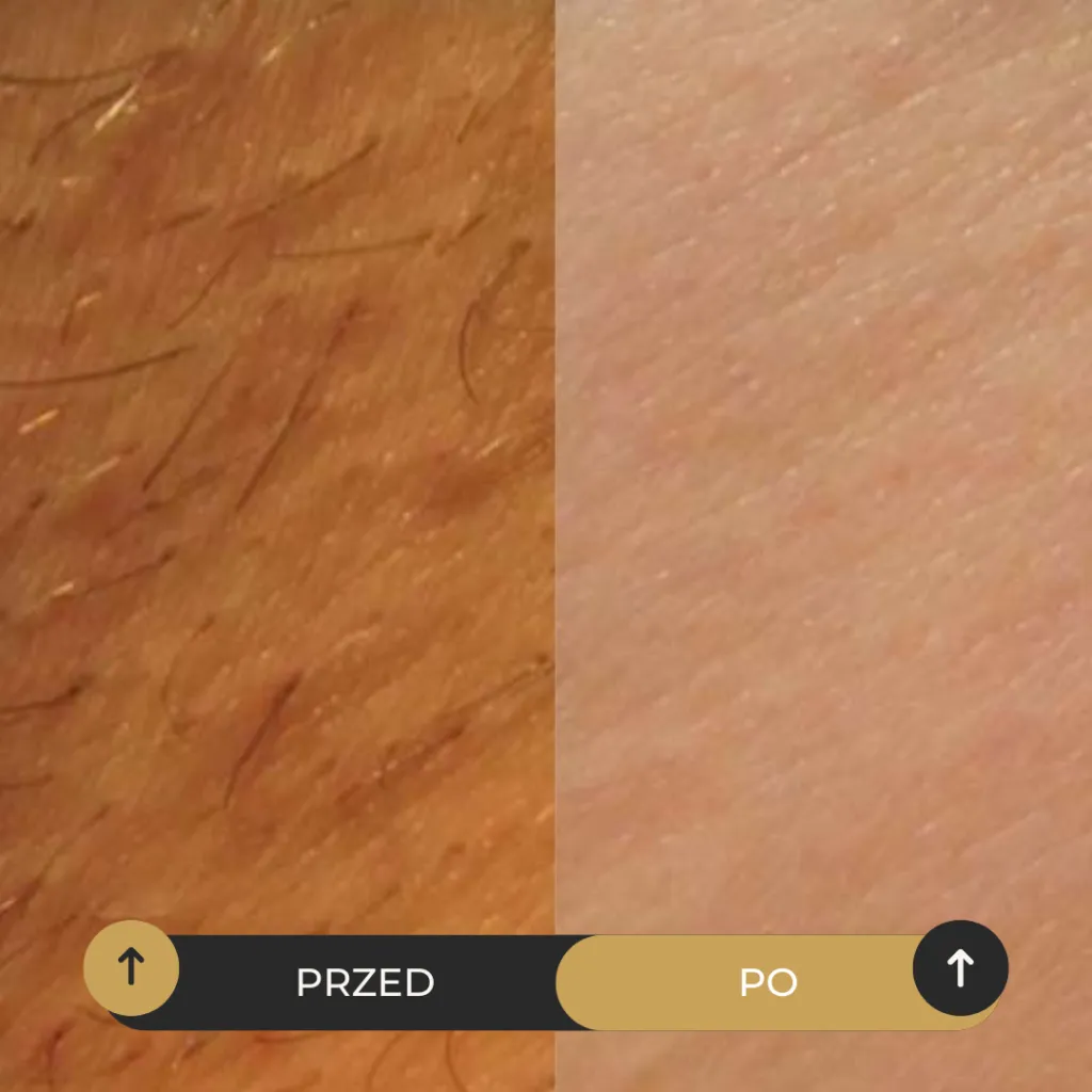 Efekt epilacji laserowej, przed i po