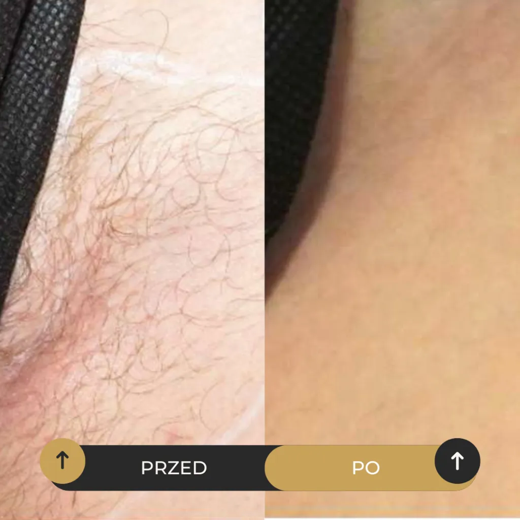 Efekt epilacji laserowej, przed i po